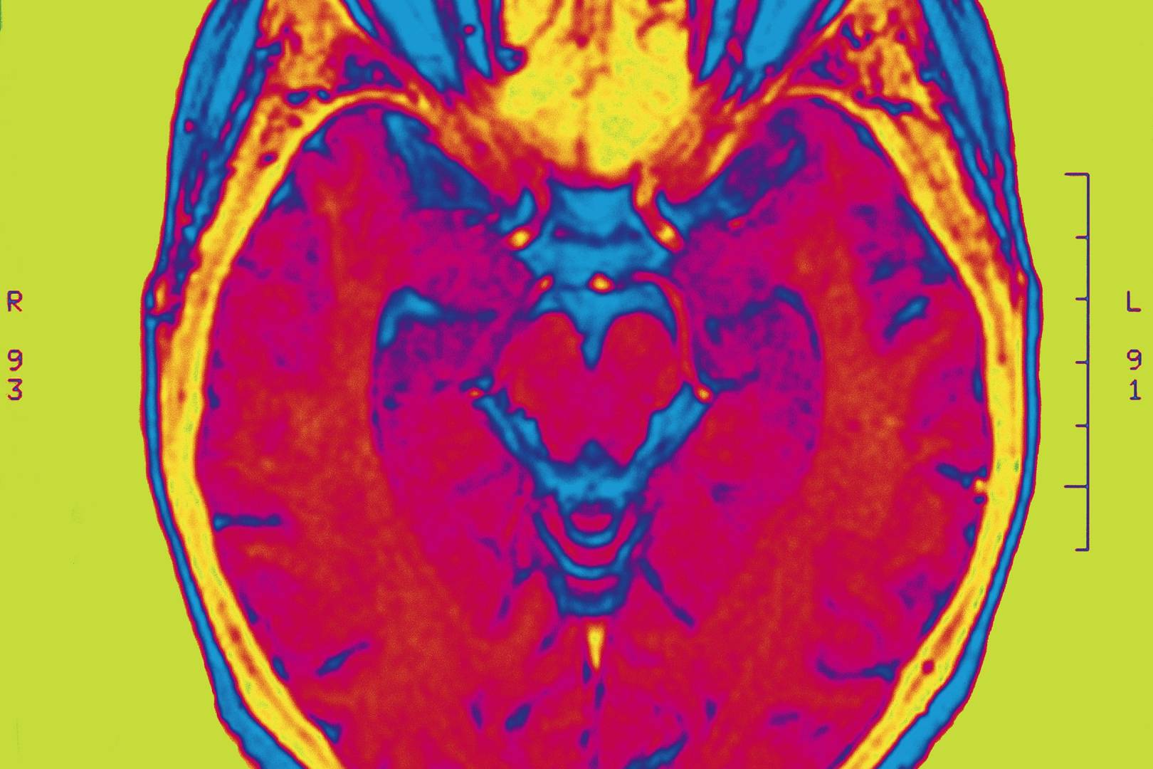 Changes in the teenage brain give clues to mental health issues