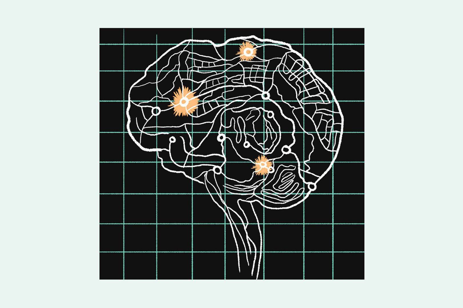 What really causes migraines is revealed