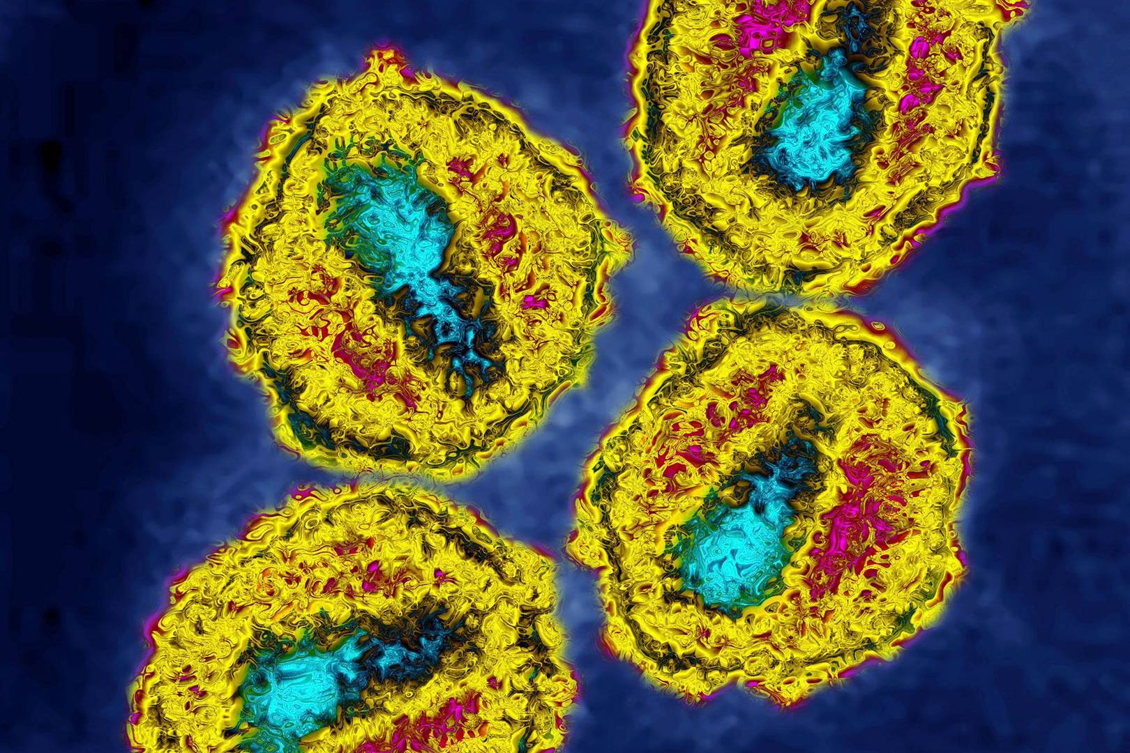 HIV cure closer after trial clears virus in British man