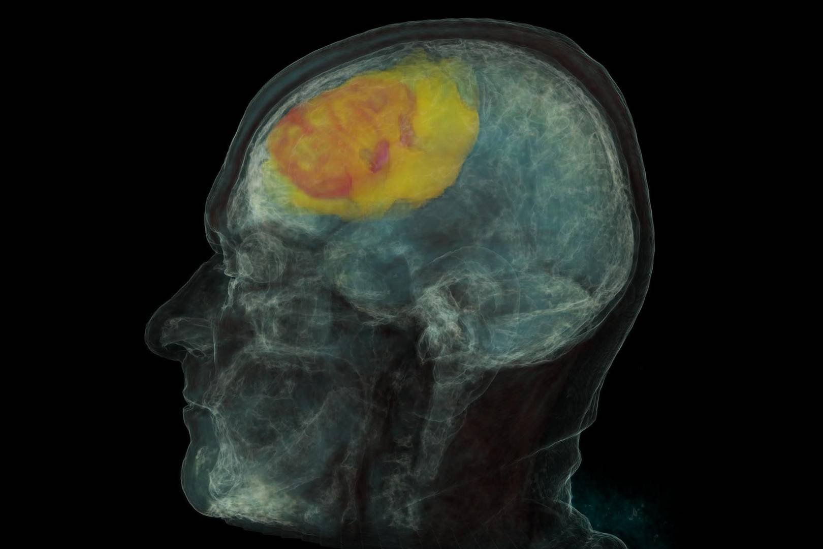 Microsoft wants to 'solve' cancer in the next 10 years using AI