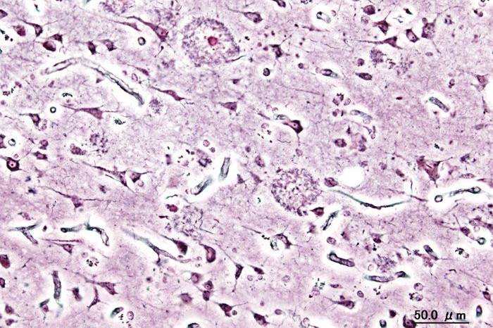 Alzheimer's disease and dementia: what's the difference?