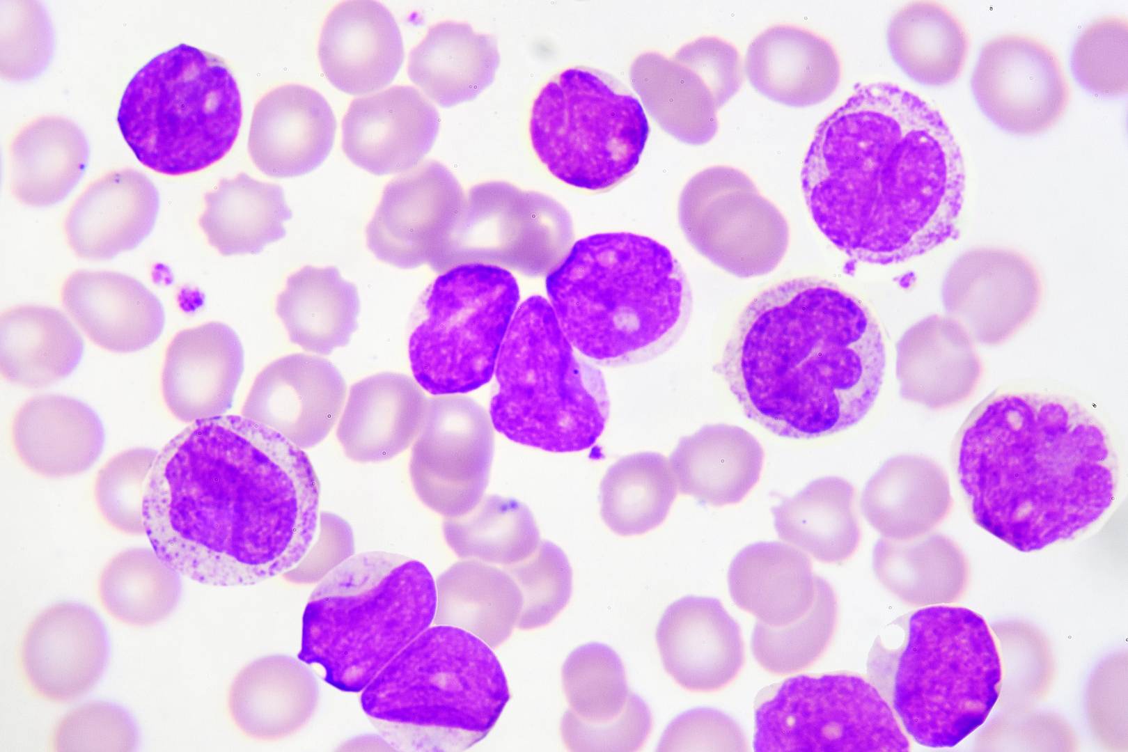 Thursday Briefing: Leukaemia gene therapy approved in the USA
