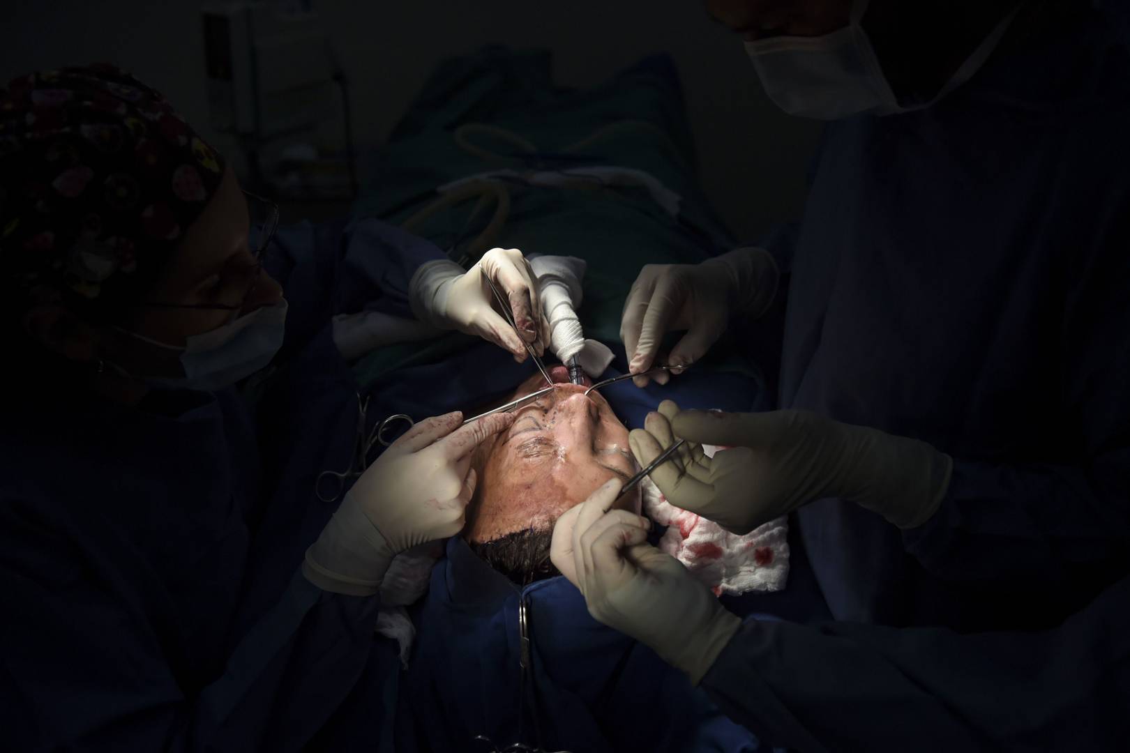 Acid attacks are on the rise, but lazy media coverage isn't helping