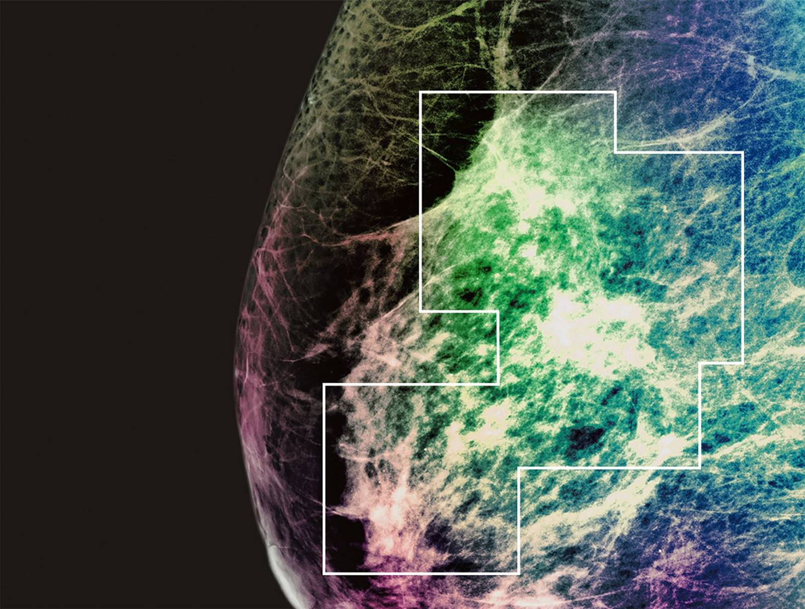 Radiology by robots: this is what breast cancer looks like tumour-hunting AI