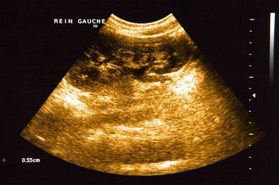 Normal ultrasound scan of the left kidney
