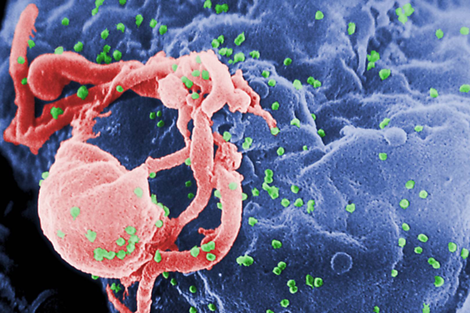 HIV cure inches closer with second successful stem cell transplant