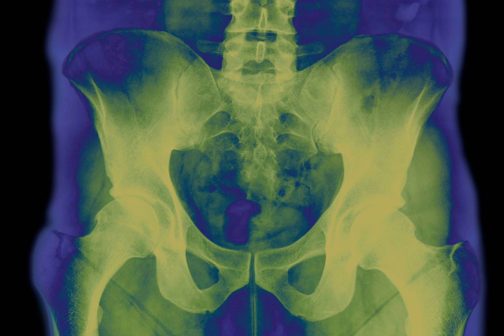 Why don't men have penis bones? Blame monogamy