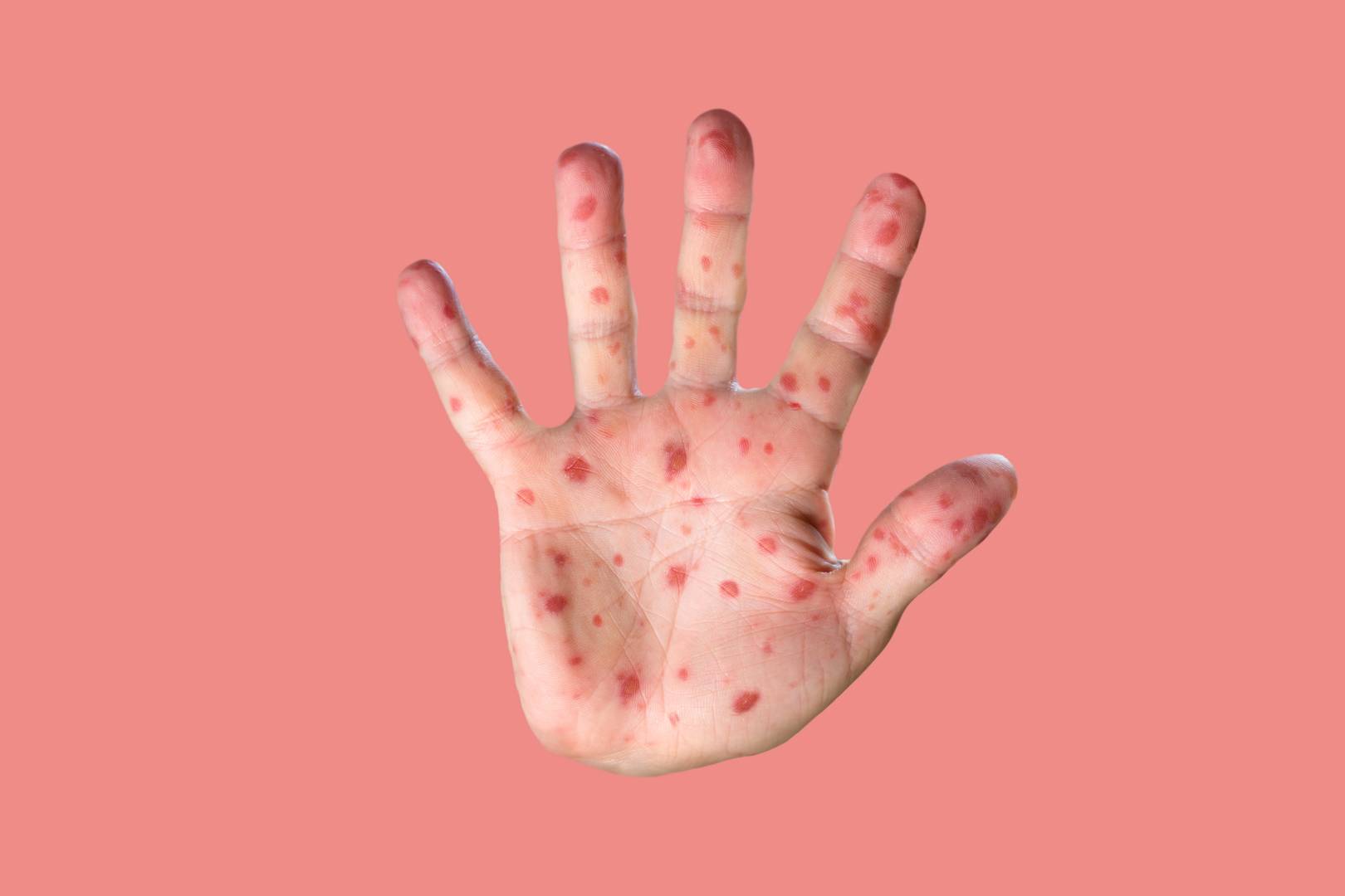 The UK losing its measles-free status isn't just about anti-vaxxers