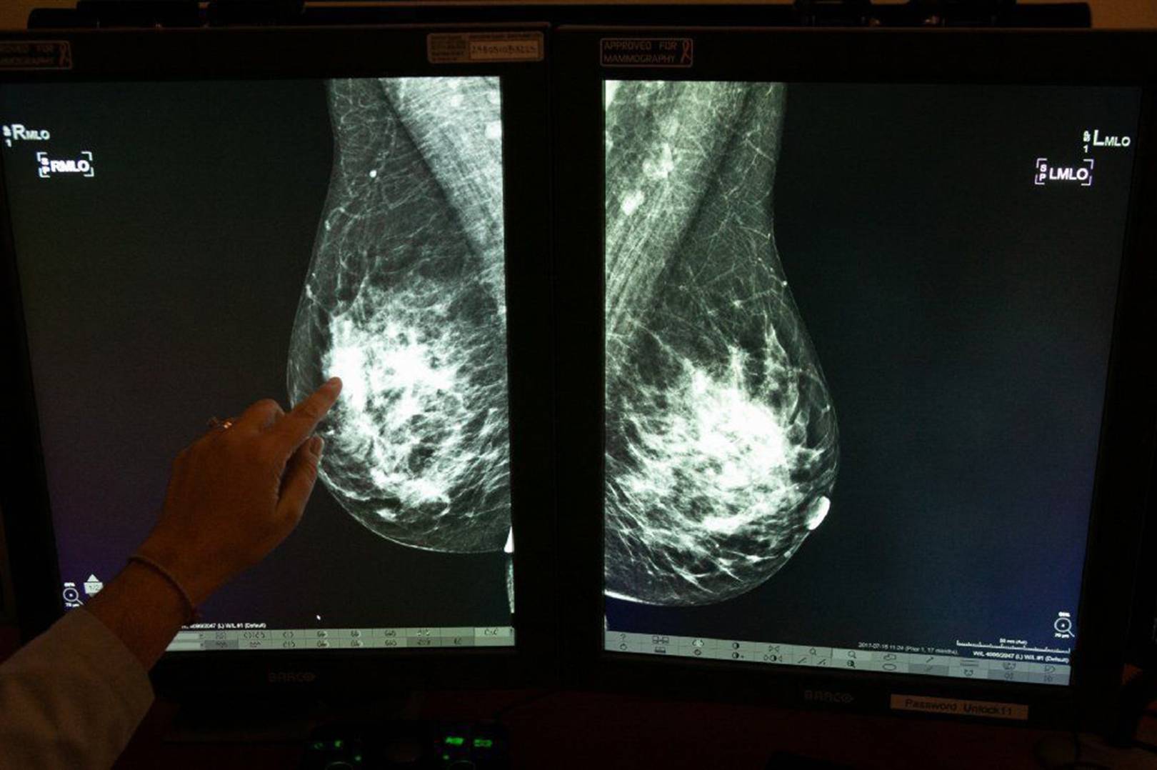 DeepMind's new AI can spot breast cancer just as well as your doctor