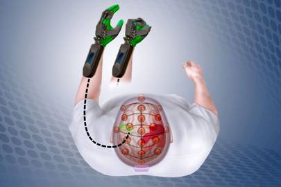 An illustration shows how the Ipsihand detects electrical signals in the uninjured part of the brain (green), and opens and closes a plastic brace fitted onto the paralyzed hand (green). By doing this, it helps train the uninjured brain areas to take over functions previously performed by injured areas (red).